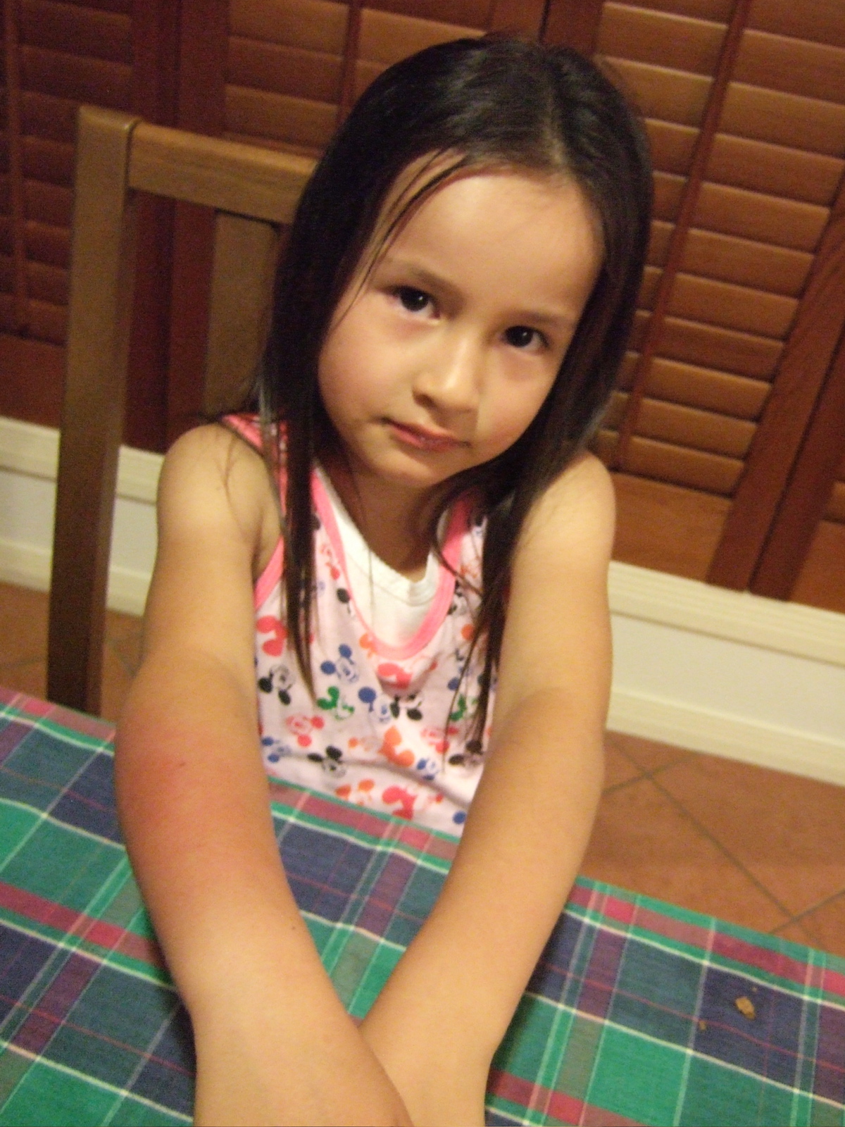 Swollen hand